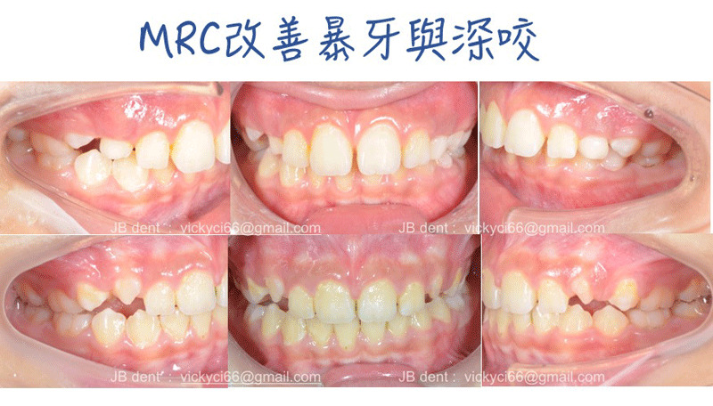 案例-1