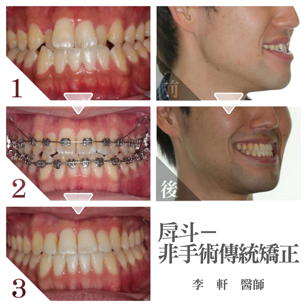 案例-1