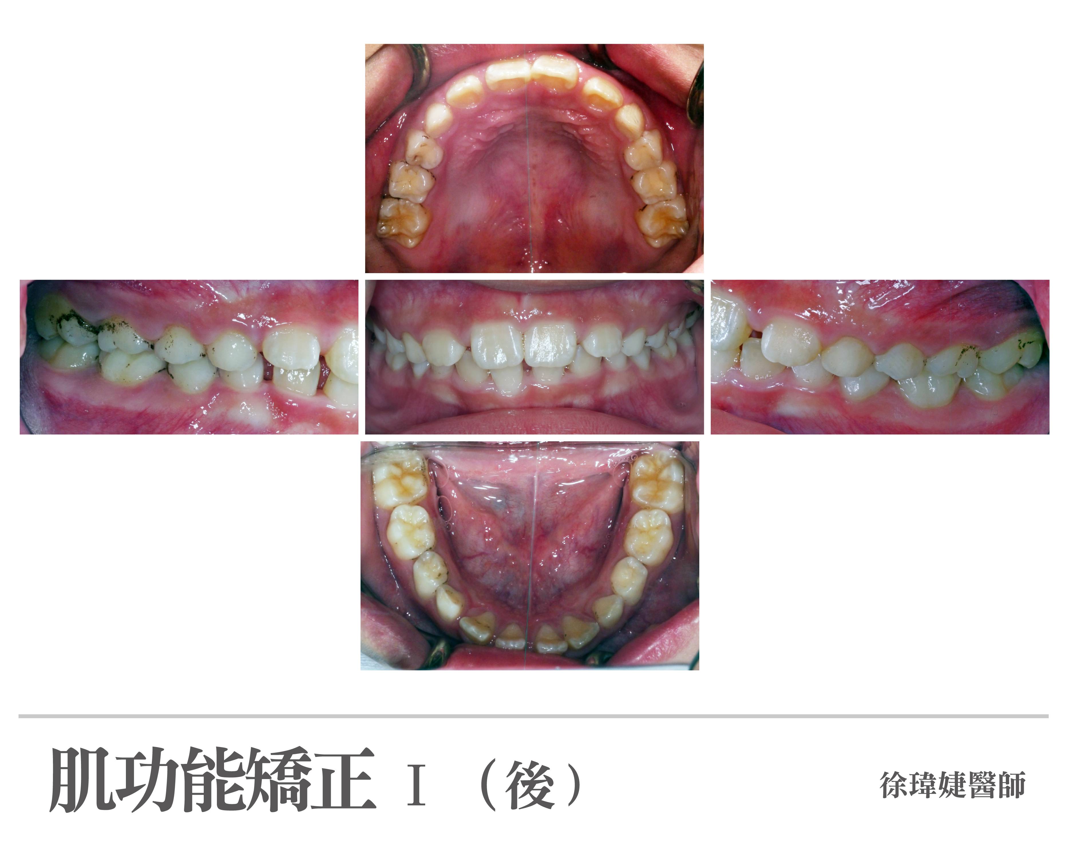 案例-1